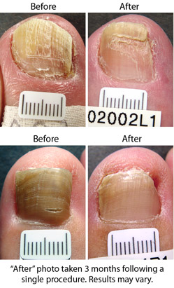 Before and After Nail Fungus Treatment What can I expect at California Skin