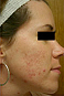PTD After Acne Treatment