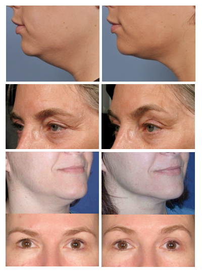 Ultherapy results