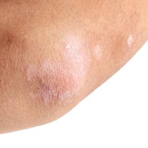 Psoriasis, California Skin Skin Insititute Psoriasis, California Skin Skin Insititute