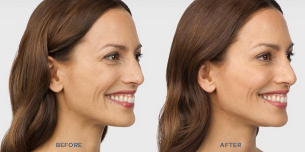 how much is botox in california how much is botox in california