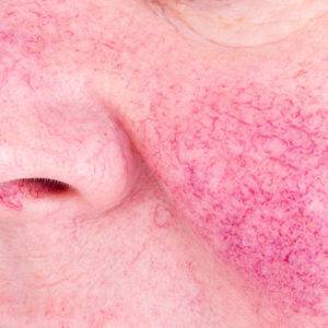 Broken Blood Vessels, California Skin Skin Insititute Broken Blood Vessels, California Skin Skin Insititute