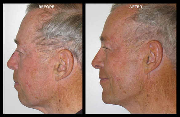 chin implants