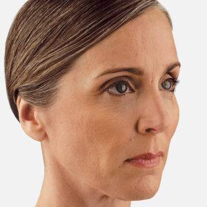Facial Volume Loss, California Skin Skin Insititute Facial Volume Loss, California Skin Skin Insititute