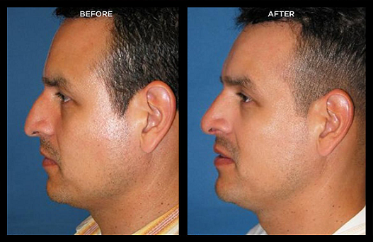 rhinoplasty