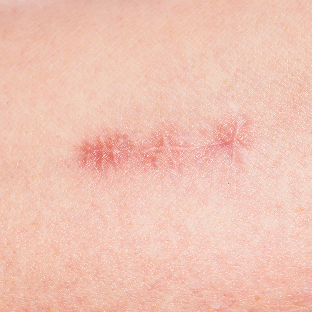 Scar Revision Before and after scar revision surgery