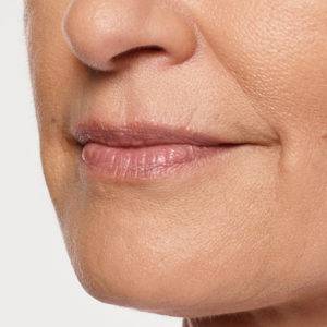 Thin Lips, California Skin Skin Insititute Thin Lips, California Skin Skin Insititute