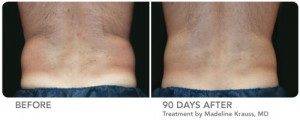 Cool Sculpting Male Patient