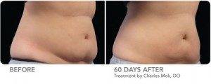 Cool Sculpting Before and After Woman 2
