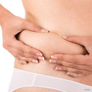 Belly Fat (Abdominal Fat), California Skin Skin Insititute Belly Fat (Abdominal Fat), California Skin Skin Insititute