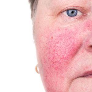 Rosacea, California Skin Skin Insititute Rosacea, California Skin Skin Insititute