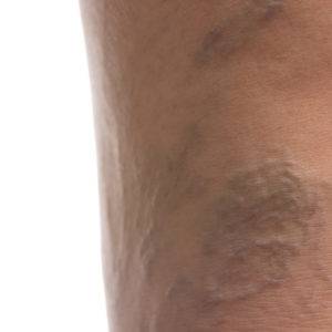 Varicose Veins, California Skin Skin Insititute Varicose Veins, California Skin Skin Insititute
