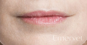 after-emervel