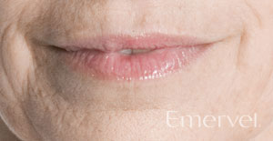 before-emervel