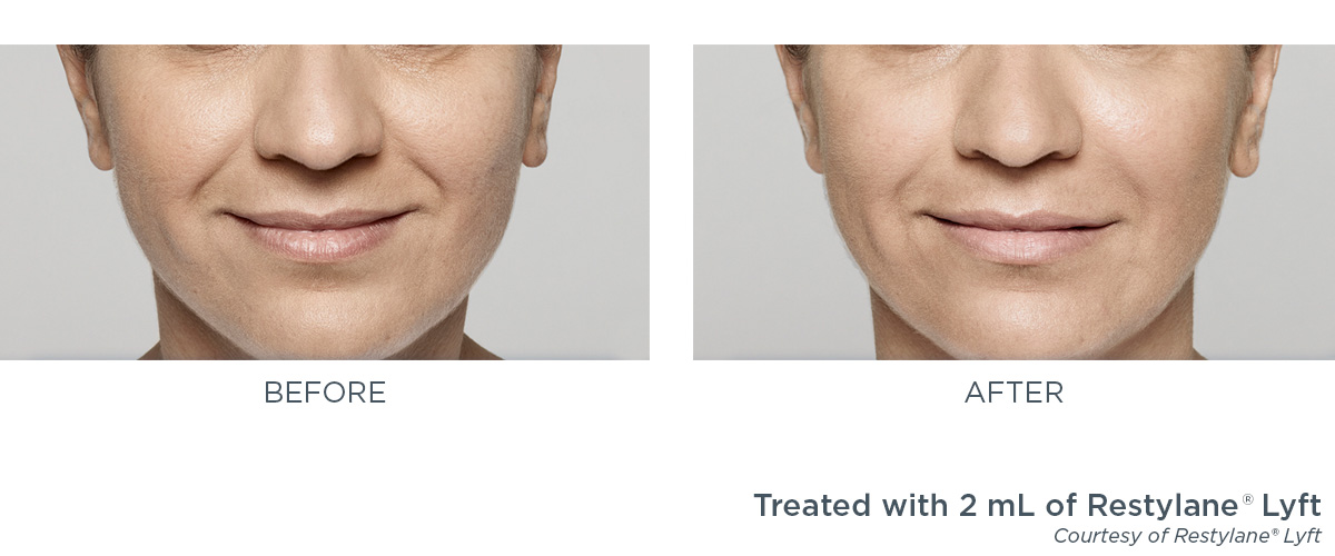 restylane-lyft-1-ba