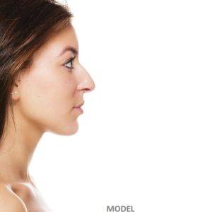 Neck Contouring with Kybella Treatments, California Skin Skin Insititute Neck Contouring with Kybella Treatments, California Skin Skin Insititute